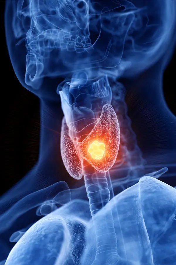 Thyroid-Imbalance-Treatment A 3D illustration of an x-ray of a human neck, highlighting the thyroid. Get help with thyroid imbalance from Kane Lai, MD in Dallas-Fort Worth Metroplex.